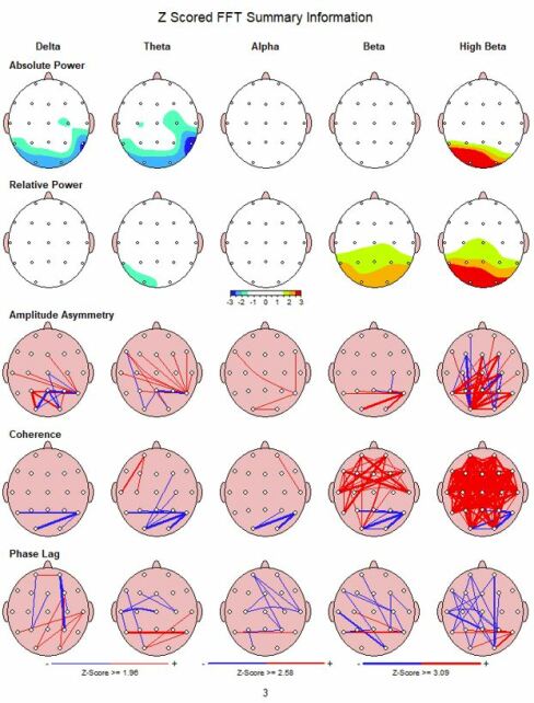 qEEG Diagnostik zScore Auswertung zur Optimierung der Neurofeeedbacktherapie